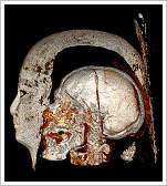 ©St. Luke’s Hospital Foundation - Computertomography of a mummy's skull